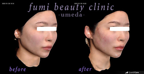 症例写真2(施術後)