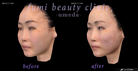 症例写真1(施術前)