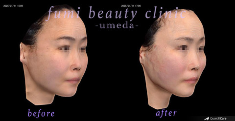 症例写真1(施術後)