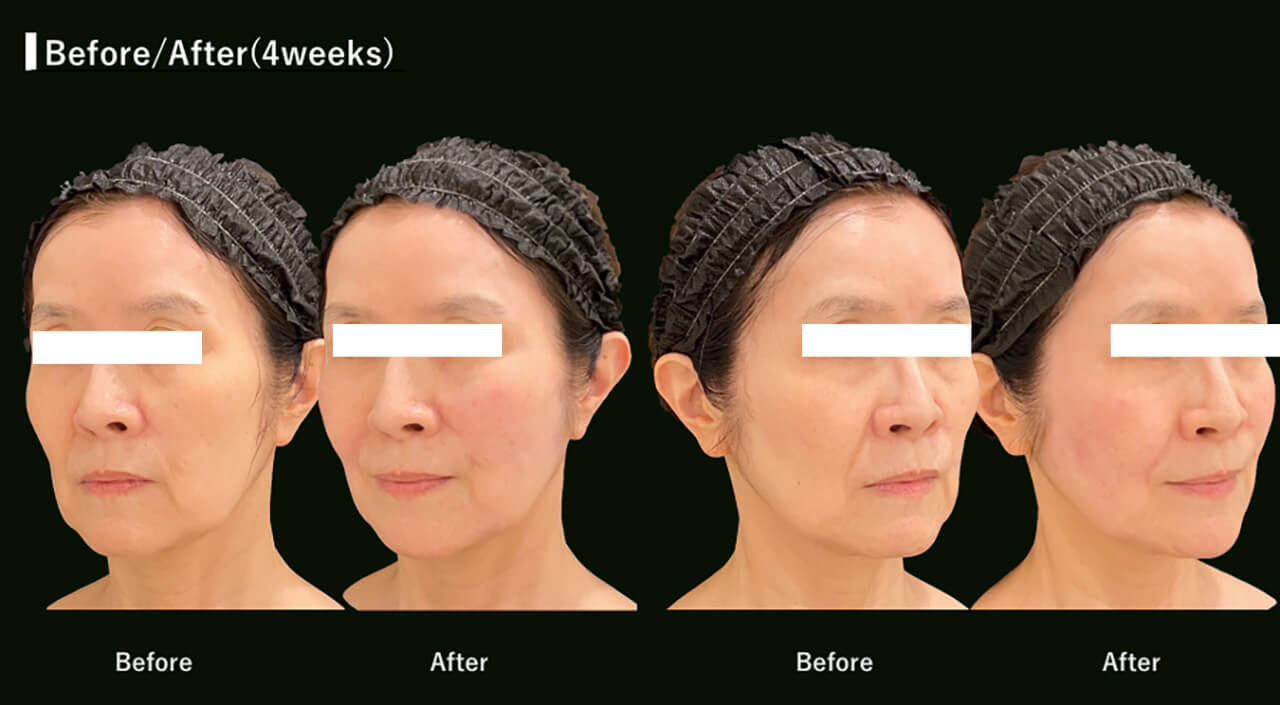 症例写真1(施術前)