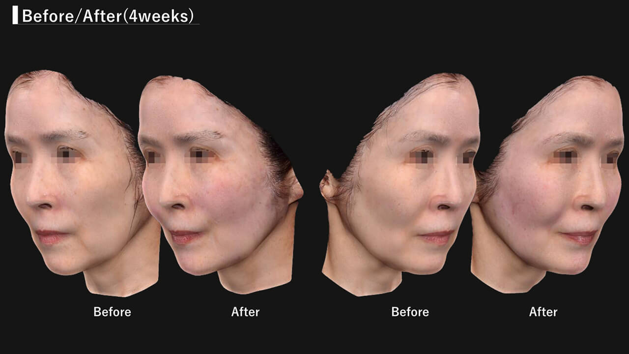 症例写真1(施術後)