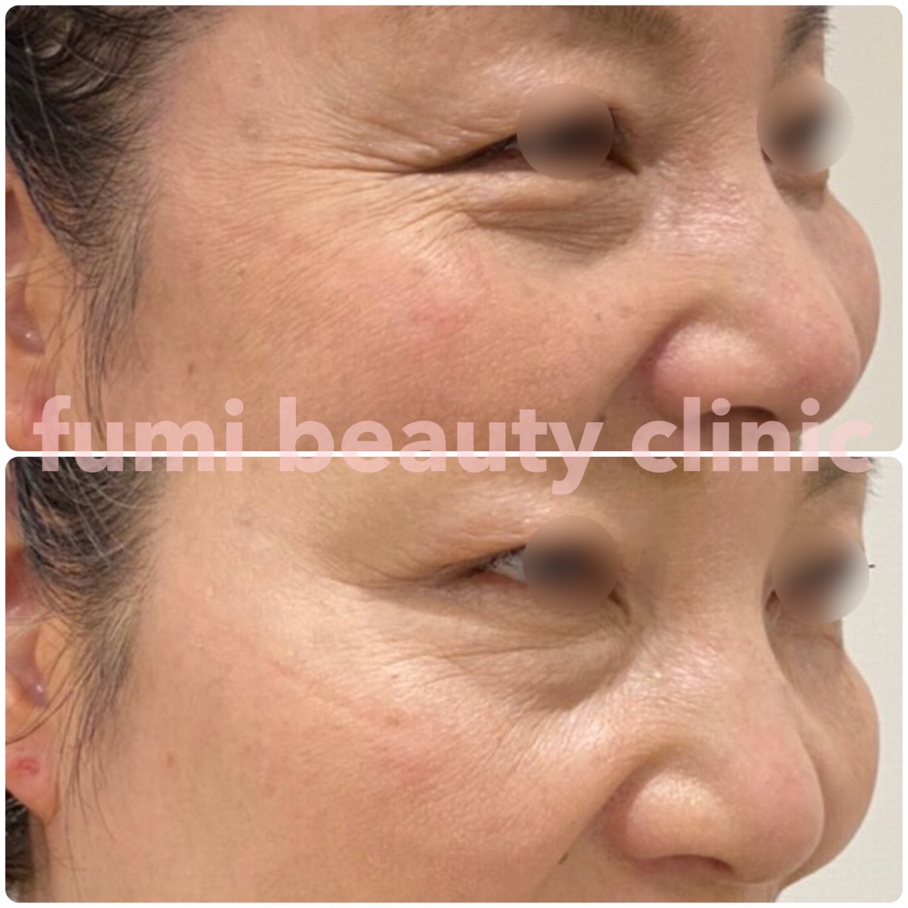 ボトックス ふみビューティクリニック梅田